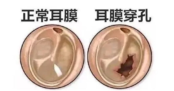 【聽(tīng)力科普】從零開(kāi)始的日常聽(tīng)力保?。ㄖ卸?圖3)